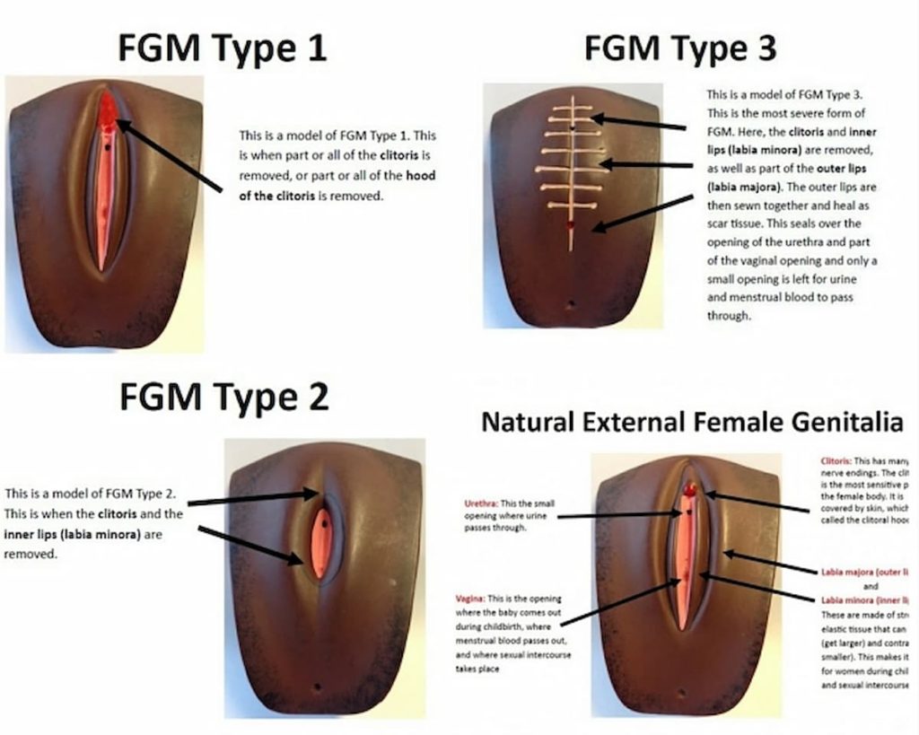 la mutilación genital femenina